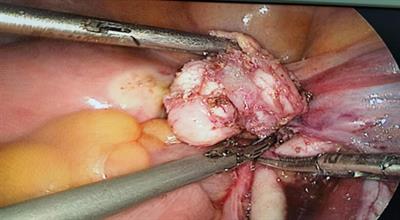 Case Report: Leiomyosarcoma of the right external iliac artery: a diagnostic-based study on a rare case